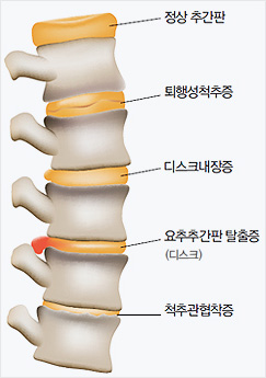 척추 사진