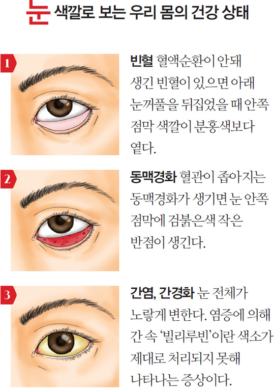 눈 색깔로 보는 우리 몸의 건강 상태 - 1. 빈혈 : 혈액순환이 안돼 생긴 빈혈이 있으면 아래 눈꺼풀을 뒤집었을 때 안쪽 점막 색깔이 분홍색보다 옅다. 2. 동맥경화 : 혈관이 좁아지는 동맥경화가 생기면 눈 안쪽 점막에 검붉은색 작은 반점이 생긴다. 3. 간염, 간경화 : 눈 전체가 노랗게 변한다. 염증에 의해 간 속 '빌리루빈'이란 색소가 제대로 처리되지 못해 나타나는 증상이다.